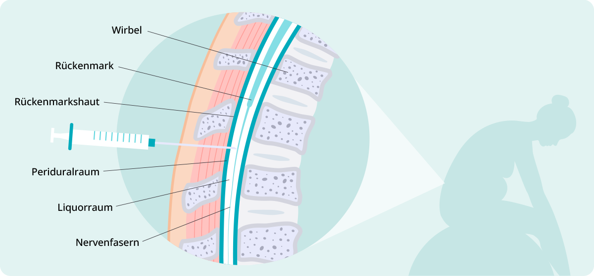 Grafik zeigt Position der Spinalanästhesie im Bereich des Spinalkanals