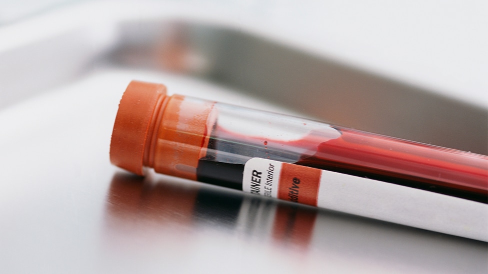 Genetische Bluttests auf Chromosomen-Abweichungen (Quelle: Tom Grill / Corbis / via Getty Images) Verschlossene Blutprobe in Reagenzglas