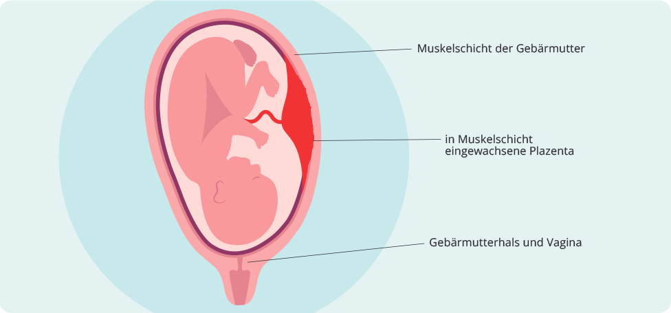 (Quelle: BIÖG) Placenta accreta