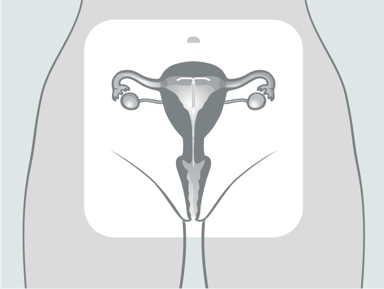 Hormonspirale in der Gebärmutter. Ein zwei Zentimeter langes Rückholfädchen schaut aus dem Muttermund heraus. Damit entfernt die Ärztin oder der Arzt die Spirale später wieder.