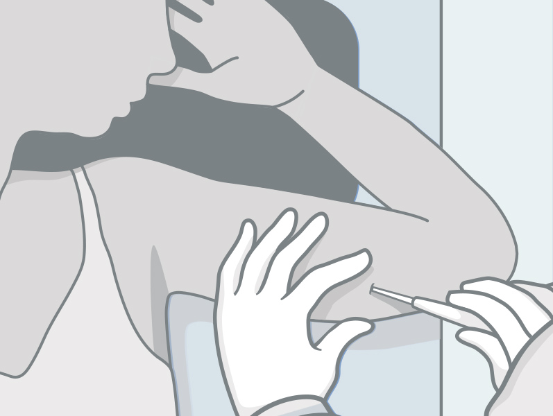 Das Hormonstäbchen wird von einer Frauenärztin oder einem Frauenarzt an der Innenseite des Oberarms unter die Haut gesetzt und bleibt dort bis zu drei Jahren.