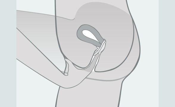 (Quelle: BIÖG) Schieben Sie das Diaphragma tief in die Vagina über den Muttermund.