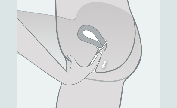 (Quelle: BIÖG) Entfernen Sie das Diaphragma frühestens 6 und spätestens 24 Stunden nach dem Geschlechtsverkehr. Zum Herausnehmen ertasten Sie mit einem Finger die Griffmulde bzw. den Rand und ziehen das Diaphragma heraus.